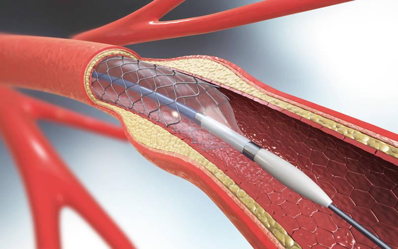 PE-backed stent maker decides to float, attracts banker pitches for IPO